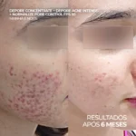Protetor Solar Facial 12HS Anti-Acne 12HS FPS 50 para Pele Oleosa e Poros – Normalize Solar Pore Control FPS 50 40ml - Imagem 4